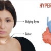 ไทรอยด์เป็นพิษหรือไฮเปอร์ไทรอยด์ (Hyperthyroid)